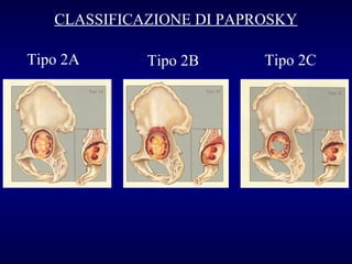 CLASSIFICAZIONE DI PAPROSKY
Tipo 2A

Tipo 2B

Tipo 2C

 