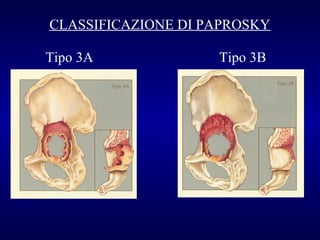 CLASSIFICAZIONE DI PAPROSKY
Tipo 3A

Tipo 3B

 