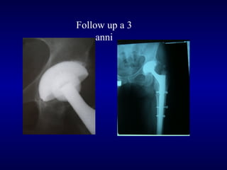 Follow up a 3
anni

 