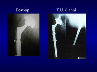 Post-op

F.U. 6 anni

 