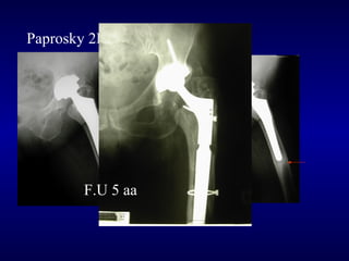 Paprosky 2B

F.U 5 aa

 