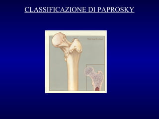 CLASSIFICAZIONE DI PAPROSKY

 