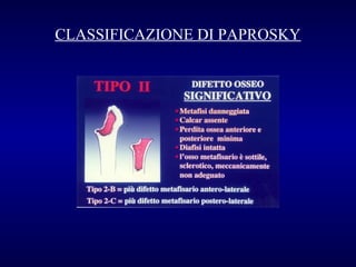 CLASSIFICAZIONE DI PAPROSKY

 