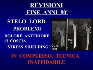 REVISIONI
FINE ANNI 80’
STELO LORD
PROBLEMI
- DOLORE ANTERIORE
di COSCIA
- “STRESS SHIELDING”

IN COMPLESSO, TECNICA
INAFFIDABILE

 