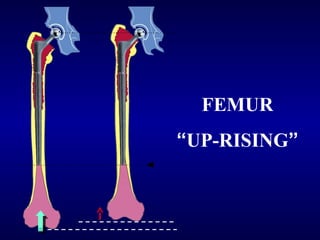 FEMUR
“UP-RISING”

 