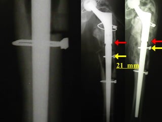 Paprosky
3-B (4)
Vanc. B - 3

21 mm

 