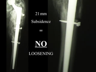 21 mm
Subsidence

=

NO
LOOSENING

 