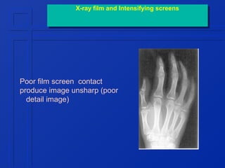 X-ray film and Intensifying screens
X-ray film and Intensifying screens

Poor film screen contact
produce image unsharp (poor
detail image)

 