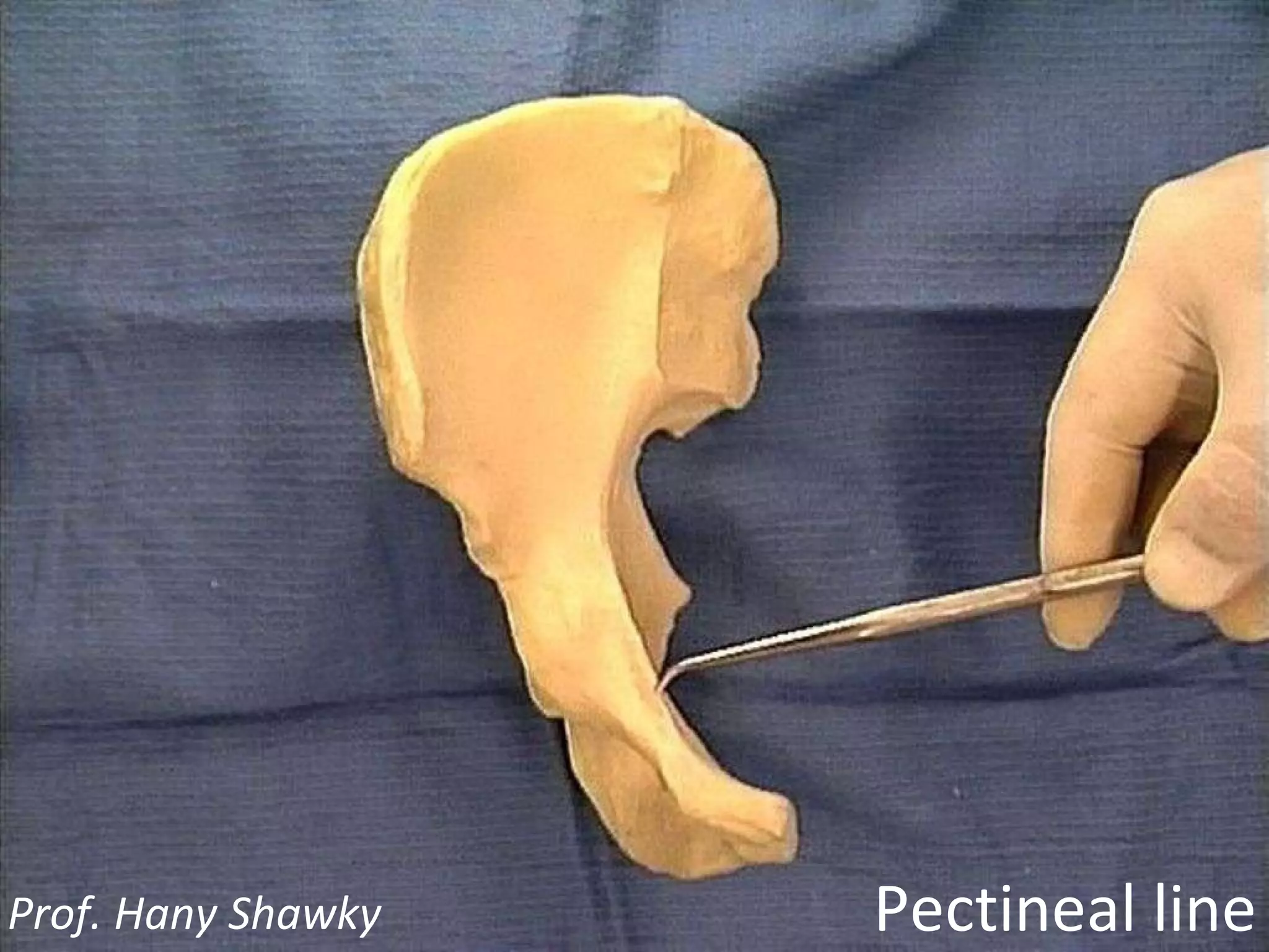 Pectineal line Prof. Hany Shawky