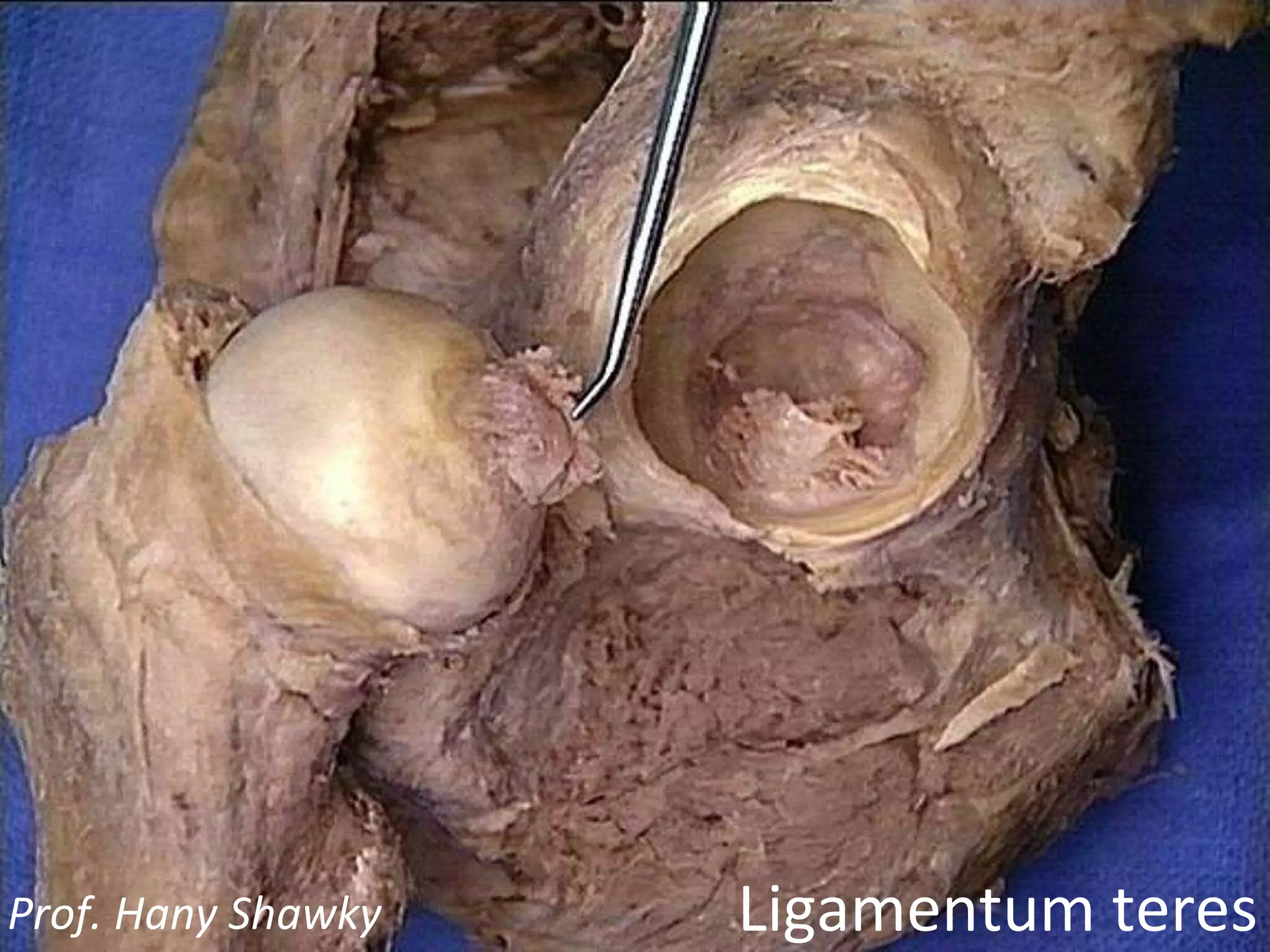 Ligamentum teres Prof. Hany Shawky