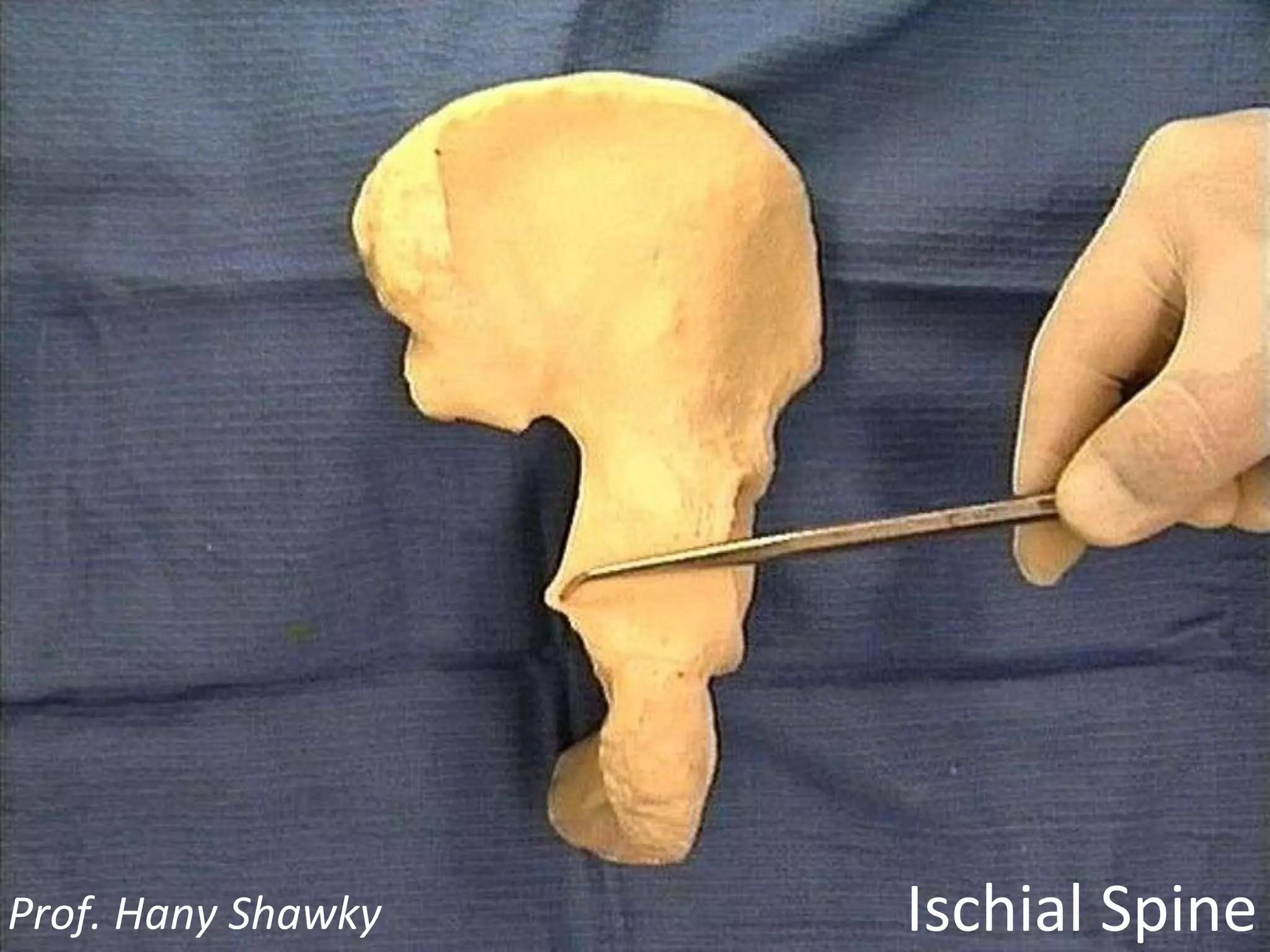 Ischial Spine Prof. Hany Shawky
