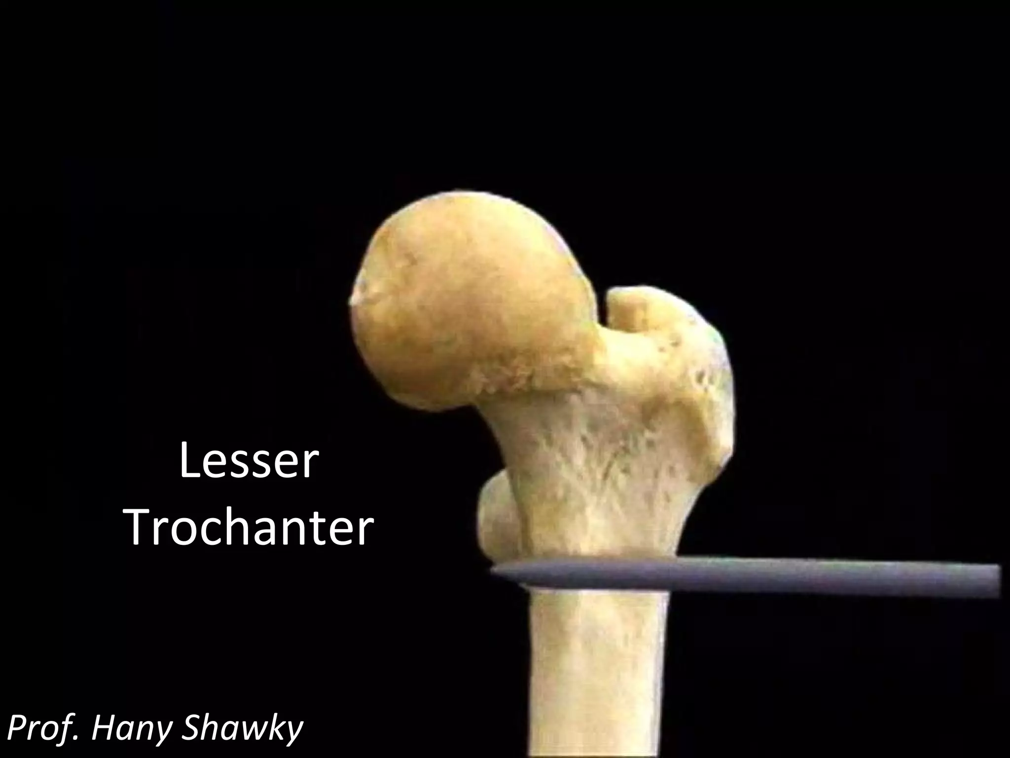 Lesser Trochanter Prof. Hany Shawky