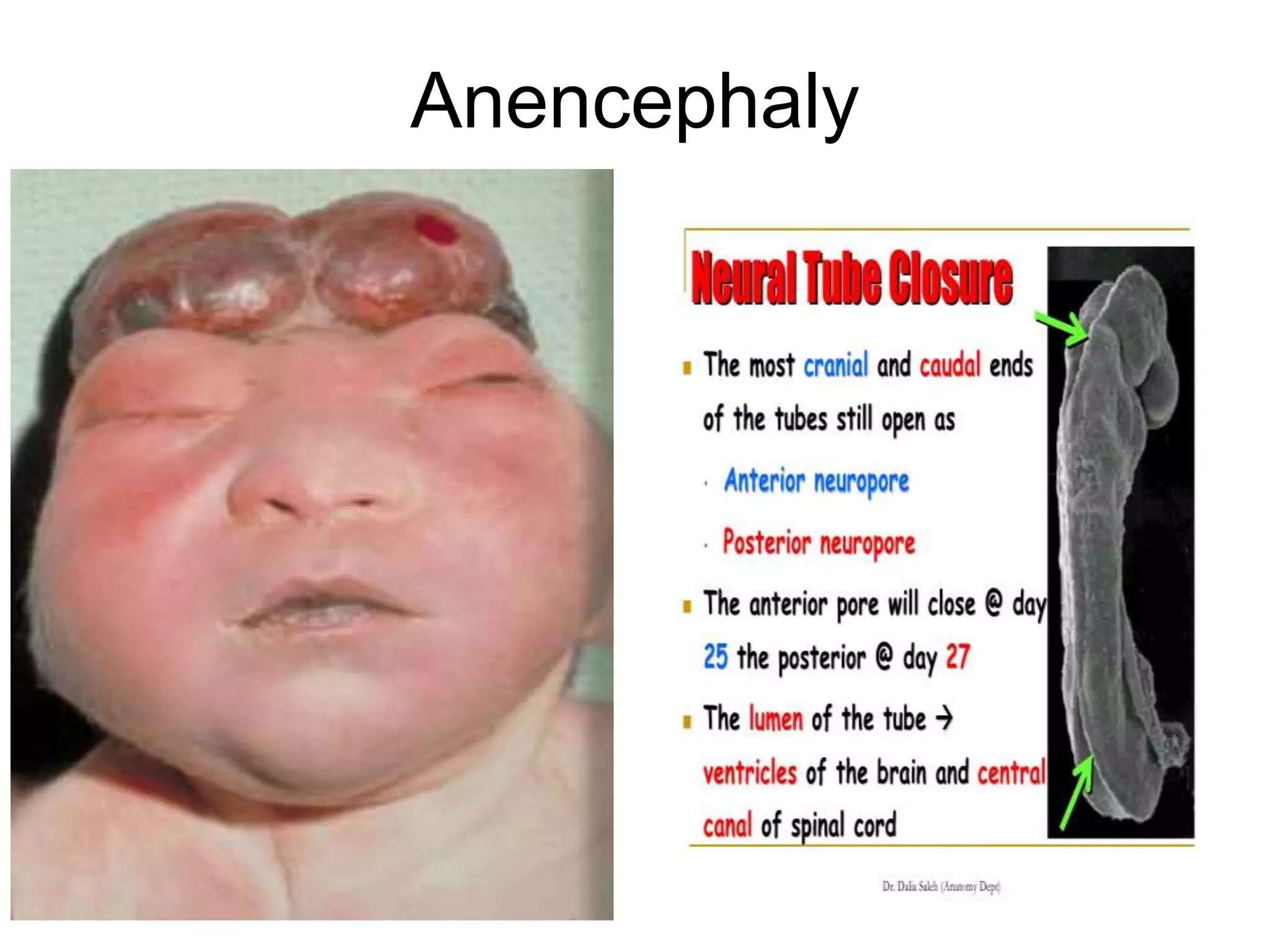 Anencephaly
5/12/2016 30
 