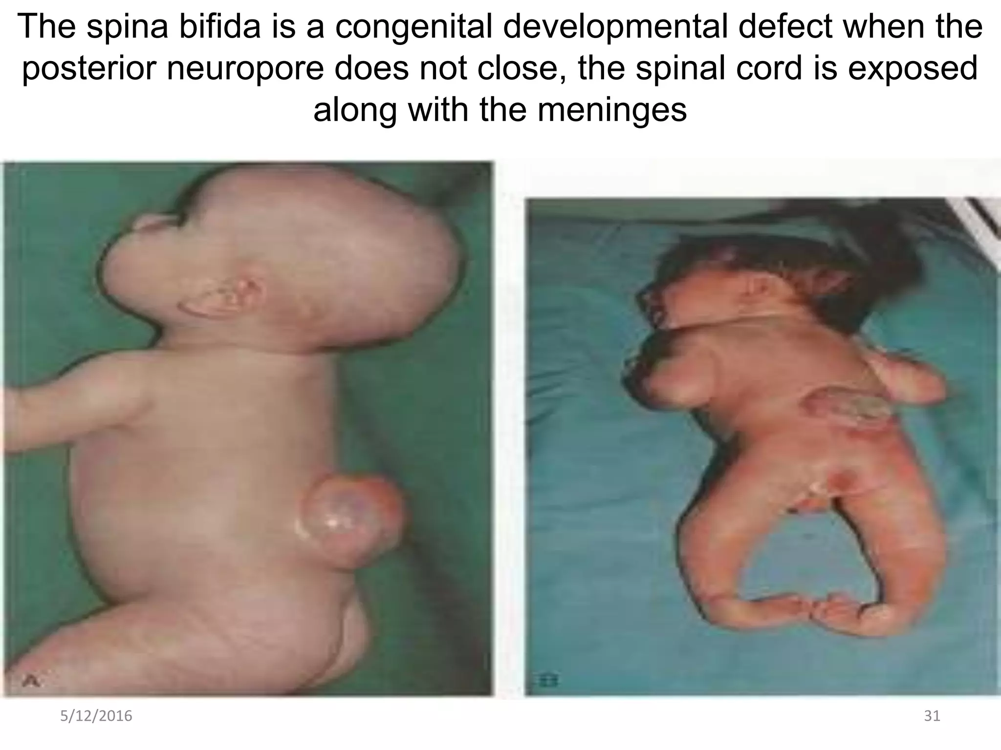 The spina bifida is a congenital developmental defect when the
posterior neuropore does not close, the spinal cord is exposed
along with the meninges
5/12/2016 31
 