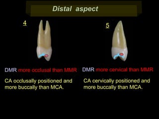 Distal aspect
4

5

DMR more occlusal than MMR

DMR more cervical than MMR

CA occlusally positioned and
more buccally than MCA.

CA cervically positioned and
more buccally than MCA.

 