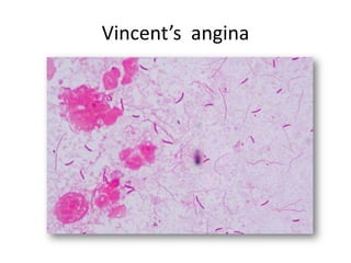 Vincent’s angina
 