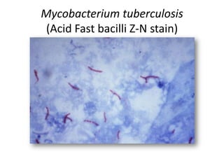 Mycobacterium tuberculosis
(Acid Fast bacilli Z-N stain)
 