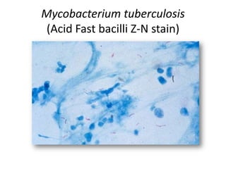 Mycobacterium tuberculosis
(Acid Fast bacilli Z-N stain)
 