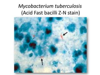 Mycobacterium tuberculosis
(Acid Fast bacilli Z-N stain)
 