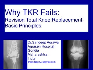 1
Why TKR Fails:
Revision Total Knee Replacement
Basic Principles
Dr.Sandeep Agrawal
Agrasen Hospital
Gondia
Maharashtra
India
drsandeep123@gmail.com
 