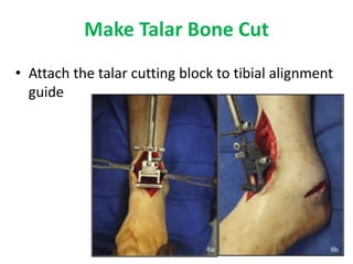 Talus Maker Ortho Journal Club 12 by Dr Saumya Agarwal | PPTX