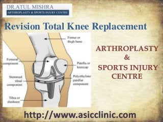 Revision Total Knee Replacement
 