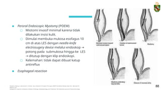 Miotomi Ruke (Revisi) PPT Disfagia + Achalasia- Kelompok 4.pptx