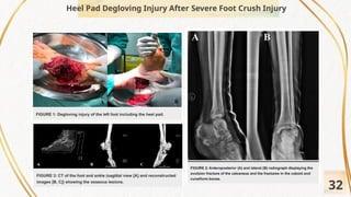 Revisi PPT Referat Open Degloving Injury.pptx
