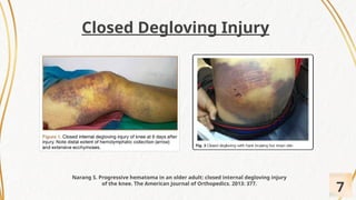 Revisi PPT Referat Open Degloving Injury.pptx