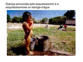 Doença provocada pelo esquistossomo é a esquistossomose ou barriga-d’água 