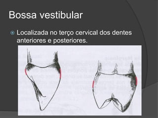 Bossa vestibular
   Localizada no terço cervical dos dentes
    anteriores e posteriores.
 