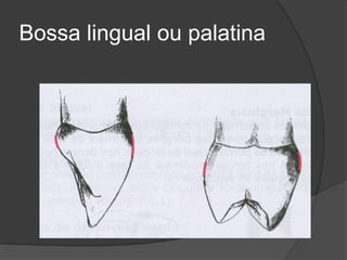 Bossa lingual ou palatina
 