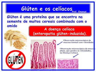 Glúten é uma proteína que se encontra na
semente de muitos cereais combinada com o
amido
A doença celíaca
(enteropatia glúten-induzida).
Glúten e os celíacosProf. Emanuel
 