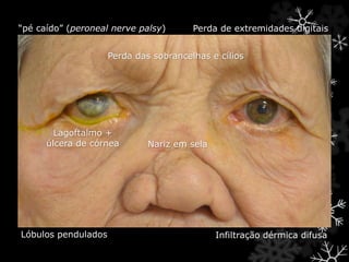 Perda das sobrancelhas e cílios
Infiltração dérmica difusaLóbulos pendulados
Nariz em sela
Lagoftalmo +
úlcera de córnea
“pé caído” (peroneal nerve palsy) Perda de extremidades digitais
 