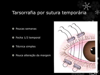 Tarsorrafia por sutura temporária
 Poucas semanas
 Fecha 1/3 temporal
 Técnica simples
 Pouca alteração da margem
 