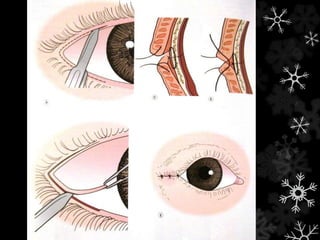 Tarsorrafia lateral permanente
 Muito efetiva
 Pode ser desfeita
 Gera deformidade na margem
 