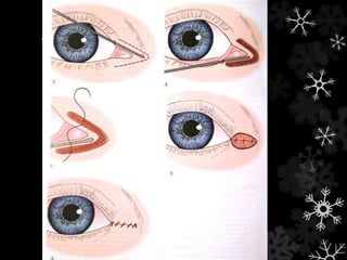 Tarsorrafia medial
 Muito útil, mas pouco conhecida (Nerad)
 Margem NÃO pode ser dividida
 Cuidado com via lacrimal
 Pode ser usada em associação
 