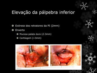 Elevação da pálpebra inferior
 Exérese dos retratores da PI (2mm)
 Enxerto
 Mucosa palato duro (2-3mm)
 Cartilagem (>3mm)
 