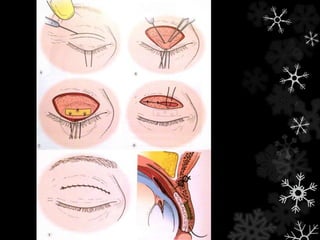 Procedimento dinâmico
 Peso de ouro
 Implantado na OS
 Testar peso no pré-op (1,2g)
 Fácil e efetivo (padrão-ouro?)
 Associação com elevação da PI
 vídeo
 