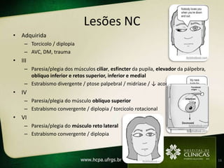 Lesões NC
• Adquirida
    – Torcicolo / diplopia
    – AVC, DM, trauma
• III
    – Paresia/plegia dos músculos ciliar, esfíncter da pupila, elevador da pálpebra,
      oblíquo inferior e retos superior, inferior e medial
    – Estrabismo divergente / ptose palpebral / midríase / ↓ acomodação
• IV
    – Paresia/plegia do músculo oblíquo superior
    – Estrabismo convergente / diplopia / torcicolo rotacional
• VI
    – Paresia/plegia do músculo reto lateral
    – Estrabismo convergente / diplopia



                                                                                       16
 