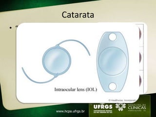 Catarata
• “Curável”
  – Tto cirúrgico
     • Fácil, seguro, custo-efetivo
     • Facectomia
        – Técnica mais antiga
        – Grande incisão (8-10mm)
     • Facoemulsificação
        –   Método preferencial
        –   2 pequenas incisões
        –   Emulsificação através de US
        –   Pode necessitar conversão
 