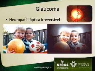 Glaucoma
• Neuropatia óptica irreversível
• Afeta visão periférica inicialmente
• 2ª maior causa de cegueira
  – Principal causa de cegueira irreversível
• FR
  – ↑PIO, idade, etnia (negros), HF
 