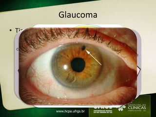 Glaucoma
• Tipos                     • Tto
  – Crônico                   – Reduz progressão
     • ângulo aberto                • Colírios
     • fechamento angular              – Β-bloqueadores
  – Agudo                               – análogos
                                          prostaglandinas
     • Ângulo fechado
                                        – α2-agonistas
  – Congênito
                                        – inibidores AC
                                    • Cirurgia/laser
 