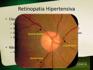 Retinopatia Hipertensiva
• Classificação Keith-Wagener-Barker
   –   Grau 1: leve estreitamento, tortuosidade ou ↑brilho
   –   Grau 2: cruzamento AV patológico, fios (cobre/prata)
   –   Grau 3: grauSinal de Bonnet
                    2 + hemorragias ou manchas algodonosas
   –   Grau 4: grau 3 + edema papila

                                            Sinal de Gunn
• Não há tratamento específico
   – Tratar HAS
                   Sinal de Salus
 