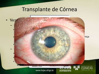 Transplante de Córnea
• Técnica                           • Complicações
  – Lamelar                              • Glaucoma
    • não retira toda a espessura        • Endoftalmite
      da córnea                          • Falha endotelial
    • Preserva camadas                   • Recorrência da doença
      profundas do receptor                primária
    • Ex.: ceratocone                    • Astigmatismo
  – Penetrante                           • Rejeição

    • Toda espessura corneana
    • Mais comum
    • Doenças que afetam
      endotélio
 