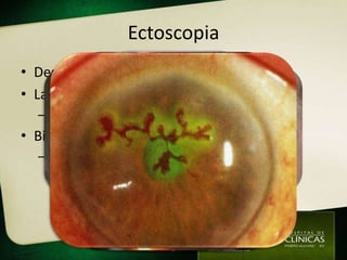 Ectoscopia
• Desarmada
• Lanterna
  – Teste de Hirschberg
• Biomicroscópio (Lâmpada de Fenda)
  – Corantes (fluoresceína, rosa bengala...)
 