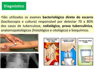 Diagnóstico
•São utilizados os exames bacteriológico direto do escarro
(baciloscopia e cultura) responsável por detectar 70 a 80%
dos casos de tuberculose, radiológico, prova tuberculínica,
anatomopatológicos (histológico e citológico) e bioquímico.
 