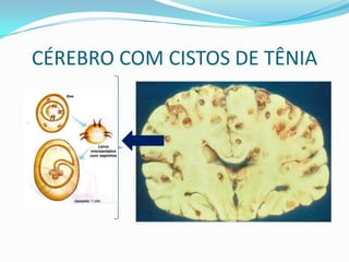 CÉREBRO COM CISTOS DE TÊNIA
 