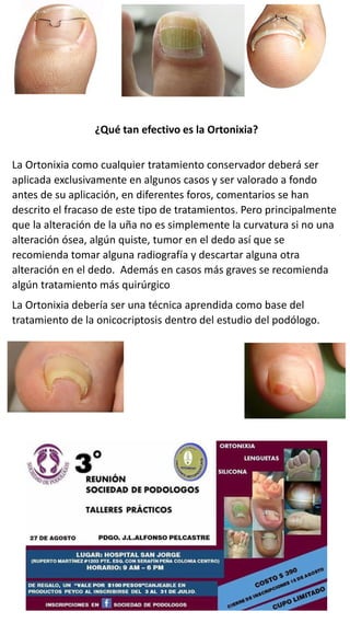 ¿Qué tan efectivo es la Ortonixia?
La Ortonixia como cualquier tratamiento conservador deberá ser
aplicada exclusivamente en algunos casos y ser valorado a fondo
antes de su aplicación, en diferentes foros, comentarios se han
descrito el fracaso de este tipo de tratamientos. Pero principalmente
que la alteración de la uña no es simplemente la curvatura si no una
alteración ósea, algún quiste, tumor en el dedo así que se
recomienda tomar alguna radiografía y descartar alguna otra
alteración en el dedo. Además en casos más graves se recomienda
algún tratamiento más quirúrgico
La Ortonixia debería ser una técnica aprendida como base del
tratamiento de la onicocriptosis dentro del estudio del podólogo.
03/08/2017 Podologia Cientifica Revista 4
 