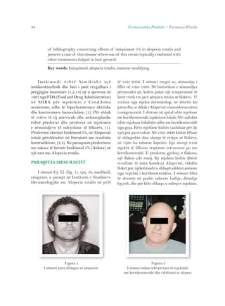 38 Farmaceutika Praktike / Farmacia Klinike 
of bibliography concerning effects of imiquimod 5% in alopecia totalis and 
present a case of this disease where use of this cream topically combined with 
other treatments helped in hair growth. 
Key words: Imiquimod, alopecia totalis, immune modifying. 
Imi k imo d i ë s h t ë k imi k i s h t n j ë 
imidazokinolinik dhe bari i parë rregullues i 
përgjigjes imunitare (1,2,14) që u aprovua në 
1997 nga FDA (Food and Drug Administration) 
në SHBA për mjekimin e Condiloma 
acuminate, edhe të hiperkeratozave aktinike 
dhe karcinomave bazocelulare, (1). Për shkak 
të vetive të tij antivirale dhe antineoplazike 
është përdorur dhe përdoret në mjekimin 
e sëmundjeve të ndryshme të lëkurës, (1). 
Përdorimi i kremit Imikimod 5%, në Alopecinë 
totale përshkruhet në literaturë me rezultate 
kontradiktore, (3,4). Ne paraqesim përdorimin 
me sukses të kremit Imikimod 5% (Aldara) në 
një rast me Alopecia totalis. 
PARAQITJA SIPAS RASTIT 
I sëmuri Gj. Ll. (fig. 1), vjeç 50, mashkull, 
emigrant, u paraqit në Institutin e Studimeve 
Dermatologjike me Alopecia totalis në prill 
të vitit 2006. I sëmuri tregoi se, sëmundja i 
filloi në vitin 1998. Në historikun e sëmundjes 
përmendet që, kishte patur një temperaturë të 
lartë rreth tre javë përpara rënies së flokëve. U 
vizitua nga mjeku dermatolog, në shtetin ku 
jeton dhe, si shkak i Alopecisë u konsiderua stresi 
i emigracionit. I shtruar në spital ishte mjekuar 
me kortikosteroidë, injeksione lokale. Në vazhdim 
ishte mjekuar lokalisht edhe me kortikosteroidë 
nga goja. Këto mjekime kishin vazhduar për dy 
vjet por pa rezultat. Në vitin 2000 kishin filluar 
të shfaqeshin disa shenja të rritjes së flokëve, 
në vijën ku mbante kapelen. Kjo shenjë nxiti 
mjekët të fillonin trajtimin intravenoz po me 
kortikosteroidë. U përdorën gjithsej 6 flakone, 
një flakon çdo muaj. Ky mjekim kishte dhënë 
rezultate të mira kundrejt Alopecisë; ridolën 
flokët por, njëkohësisht u shfaqën efektet anësore 
nga veprimi i kortikosteroidëve. I sëmuri filloi 
të shtonte në peshë, ndiente lodhje, dhimbje 
kyçesh, dhe për këto shkaqe, u ndërpre mjekimi. 
Figura 1 
I sëmuri para shfaqjes së alopecisë 
Figura 2 
I sëmuri mbas ndërprerjes së mjekimit 
me kortikosteroidë dhe rikthimit te alopeci 
 